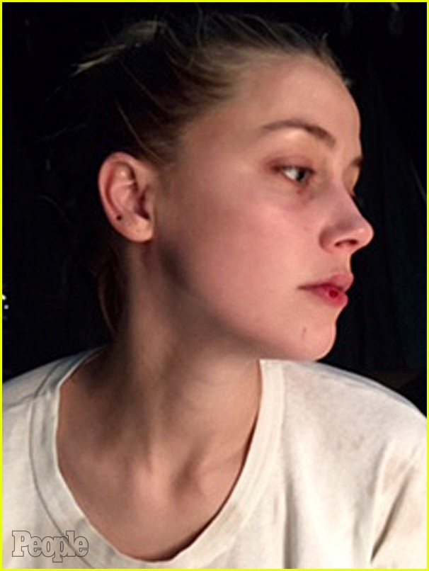 Amber Heard's Injuries Seen in New Photos, Allegedly From Johnny Depp