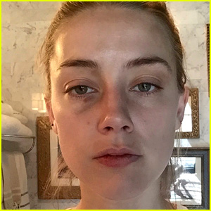 Amber Heard's Injuries Seen in New Photos, Allegedly From Johnny Depp Domestic Assault