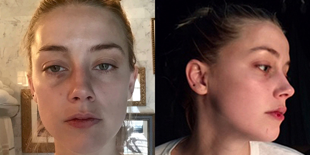 Amber Heard’s Injuries Seen in New Photos, Allegedly From Johnny Depp Domestic Assault Amber