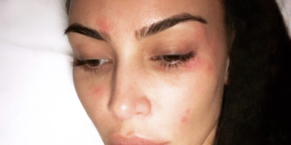 Kim Kardashian Reveals Psoriasis on Her Face in a Morning Selfie Kim