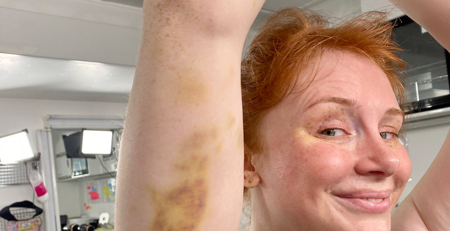Bryce Dallas Howard Shows Off Her Massive Bruises from ‘Jurassic ...